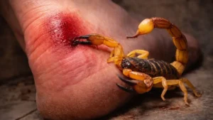 Escorpião Amarelo Picando O Pé De Uma Pessoa Com Ferrão Levantado E Pele Vermelha Ao Redor Da Área Afetada